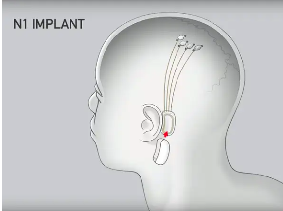Implante Neuralink | Fuente: Business Insider